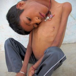 印度男童患罕见病头180度倒挂胸前 母亲不忍让其受苦希望神带走他